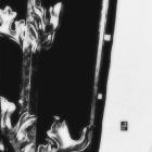 KNTZ - Cicatrization